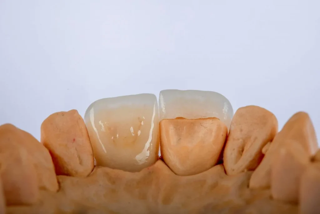 Dental Crown