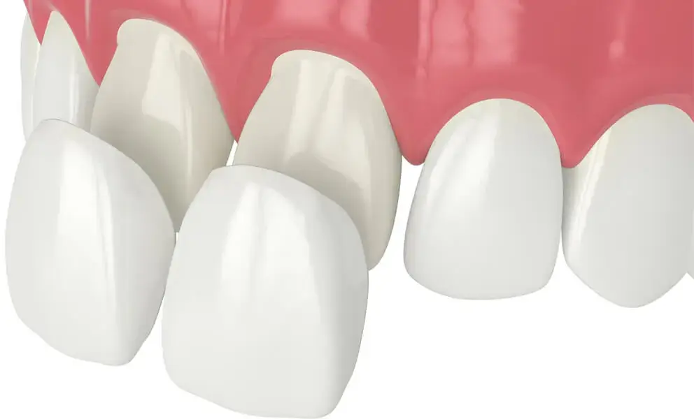 dental veneers in cary