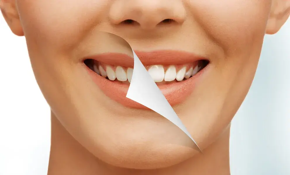 teeth whitening in cary
