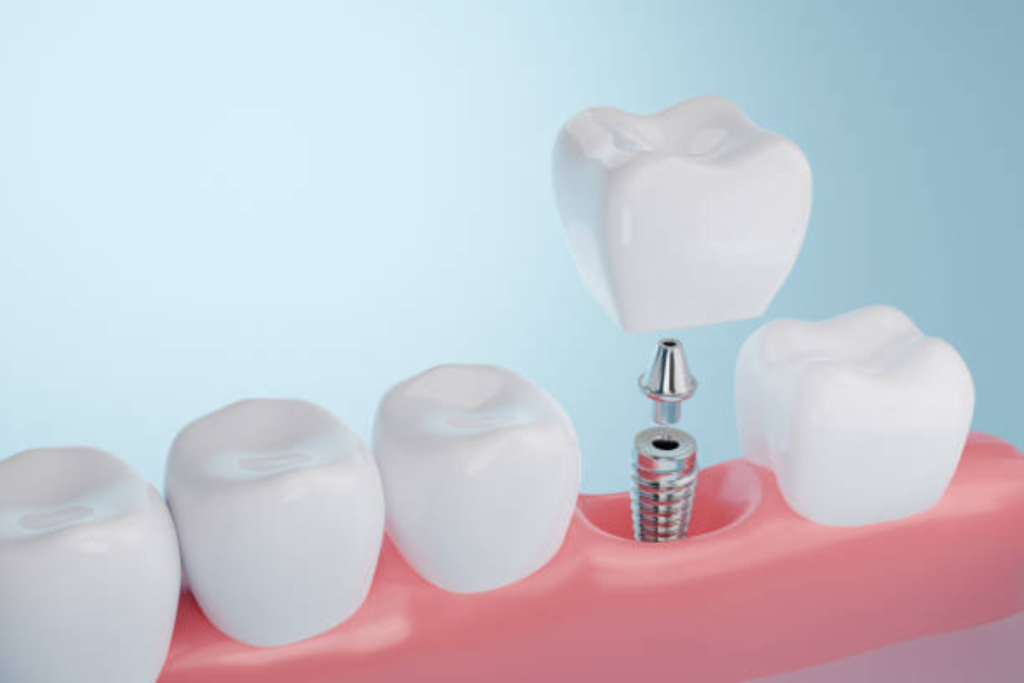 implant for one missing tooth
