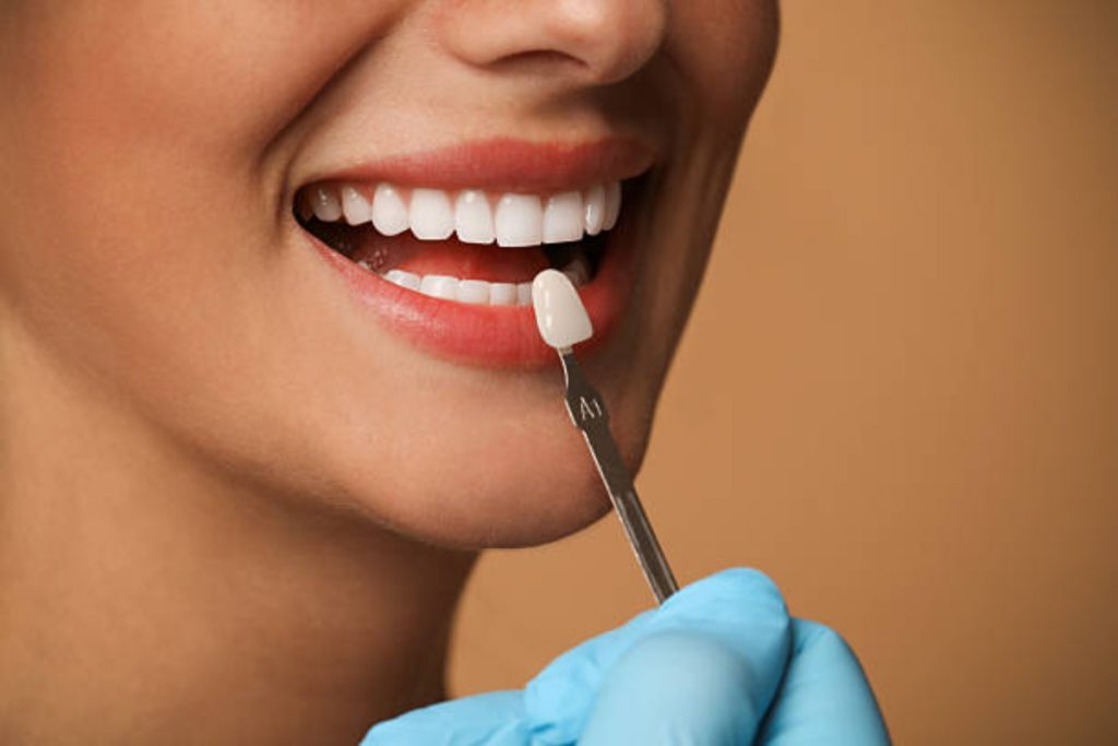 how veneers straighten slightly crooked teeth