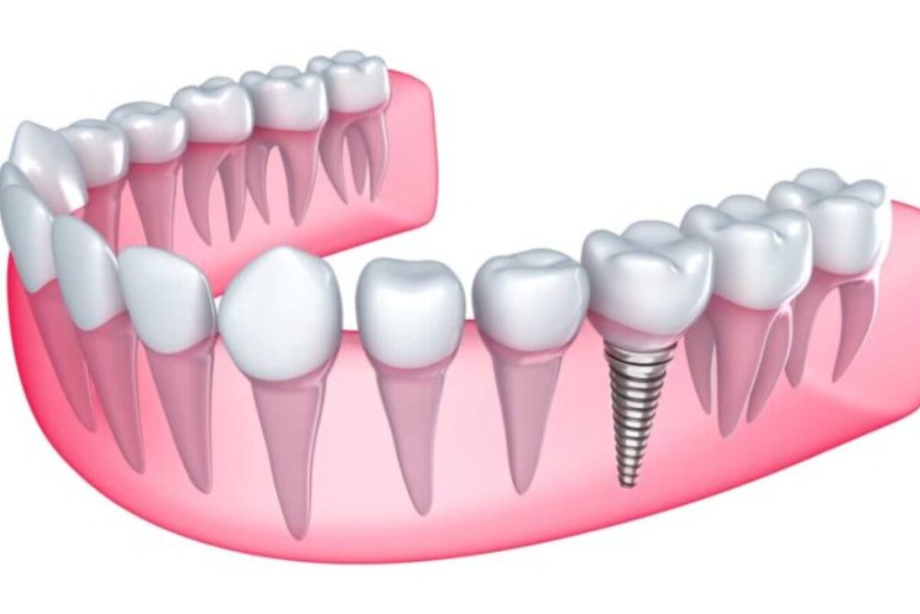 why dental implants feel more natural than dentures