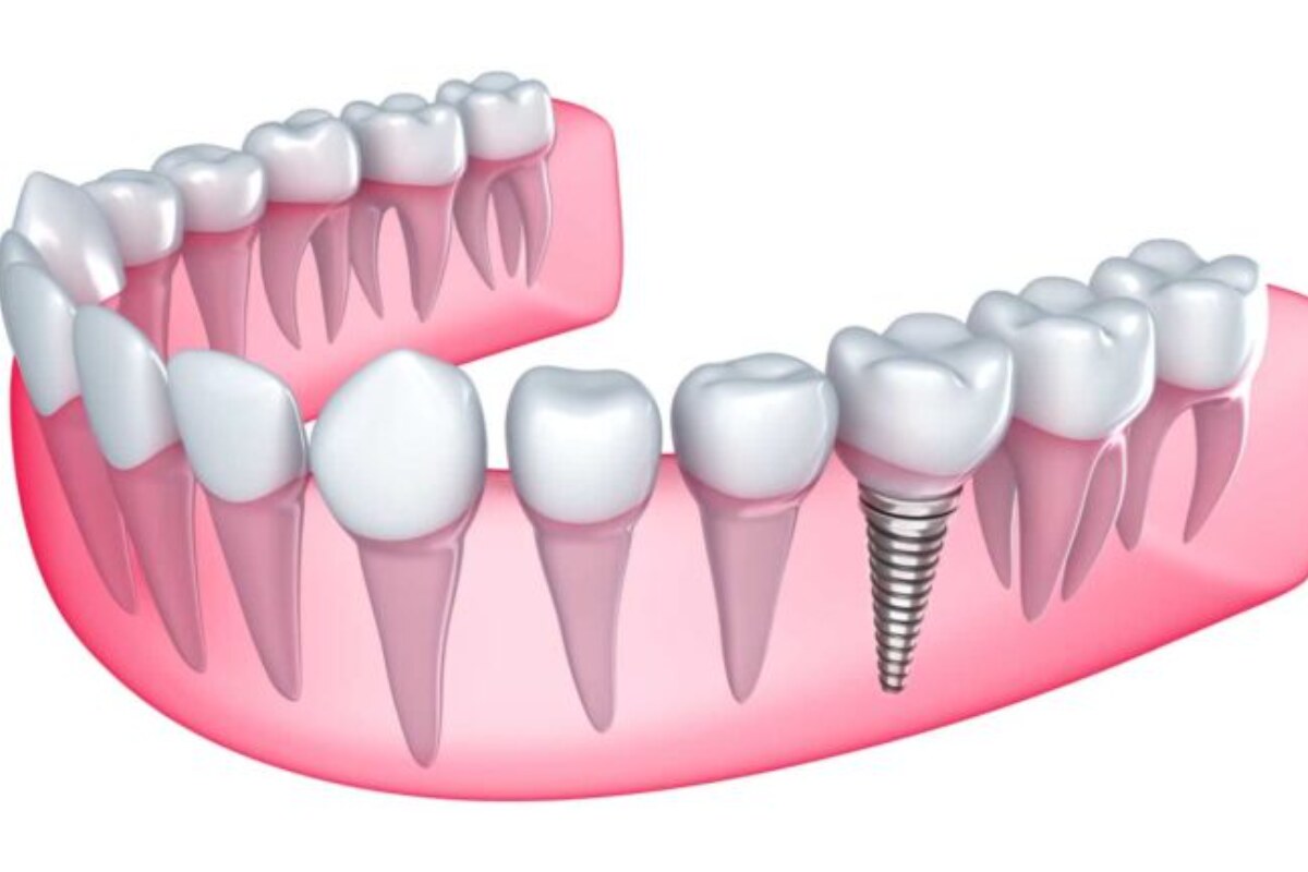 why dental implants feel more natural than dentures